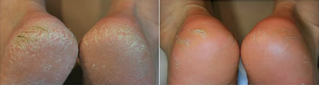 Callus Peel before and after