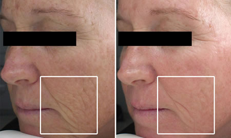 jan-marini-before-and-after